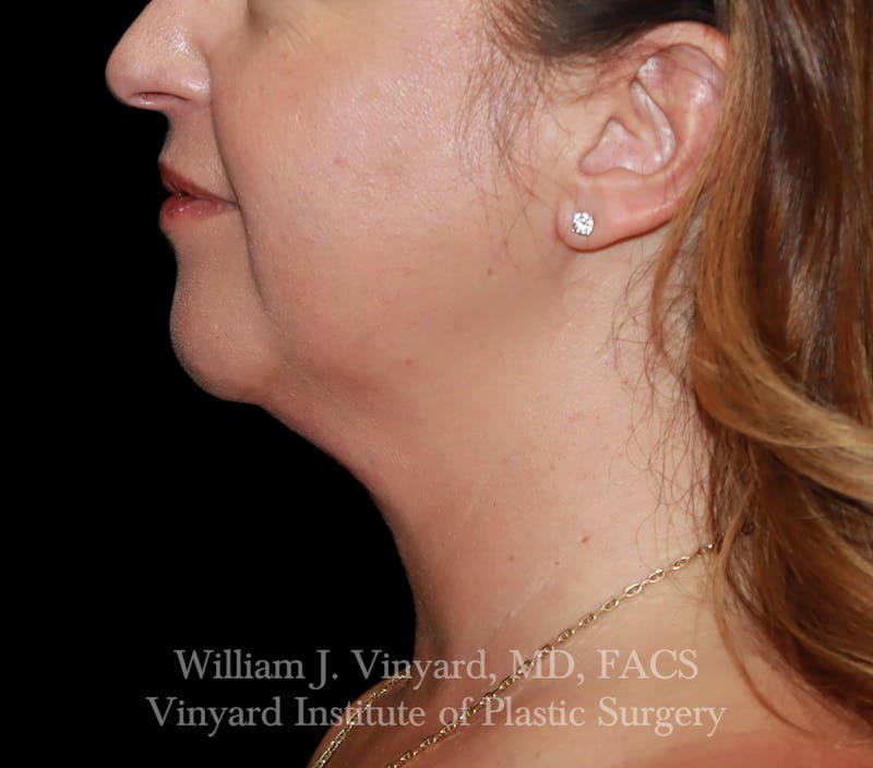 FACEtite Before & After Gallery - Patient 352050 - Image 7