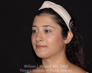 FACEtite Before & After Gallery - Patient 416096 - Image 2