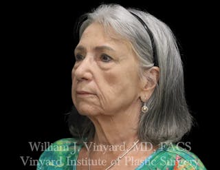 Facelift (Cheek and Neck Lift) Before & After Gallery - Patient 417546 - Image 2