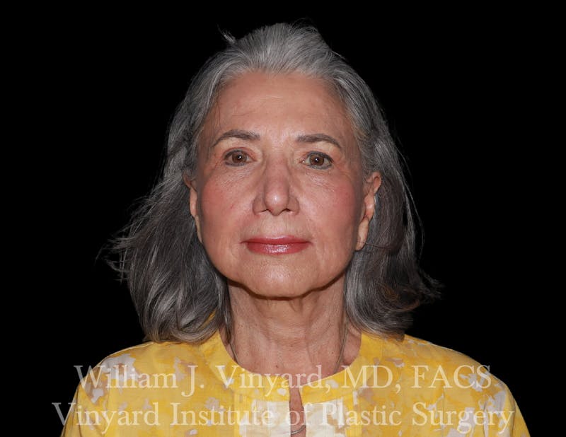 Eyelid Lift Before & After Gallery - Patient 386952 - Image 1