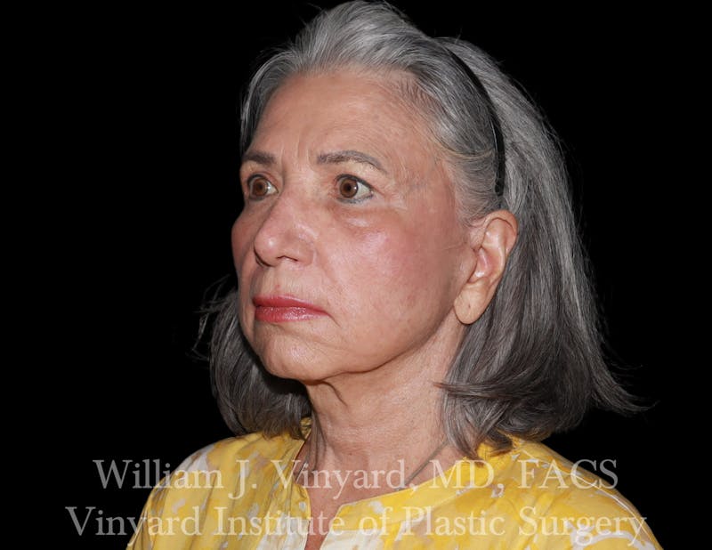 Eyelid Lift Before & After Gallery - Patient 386952 - Image 3