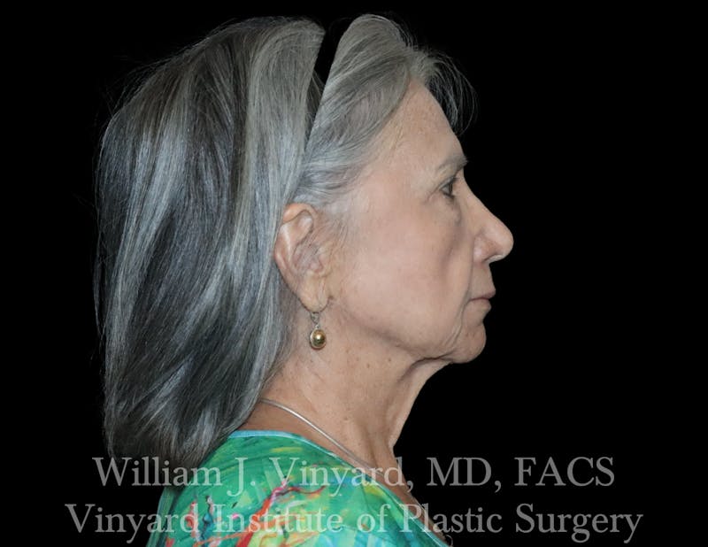 Eyelid Lift Before & After Gallery - Patient 386952 - Image 8