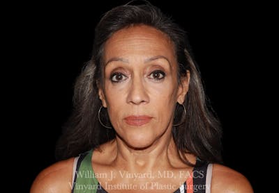 Eyelid Lift Before & After Gallery - Patient 401054 - Image 2