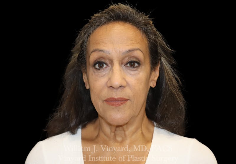 Eyelid Lift Before & After Gallery - Patient 401054 - Image 1