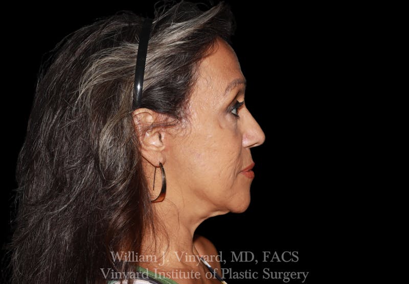 Eyelid Lift Before & After Gallery - Patient 401054 - Image 6