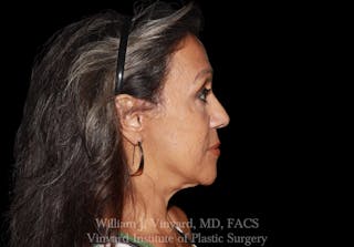 Facelift (Cheek and Neck Lift) Before & After Gallery - Patient 378513 - Image 6