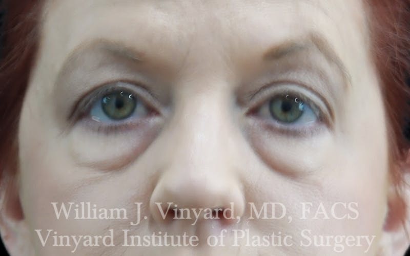 Eyelid Lift Before & After Gallery - Patient 171287 - Image 1