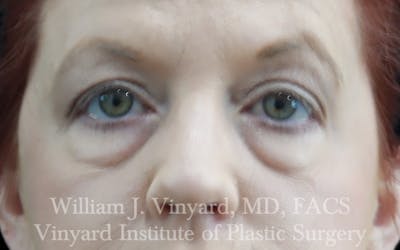 Eyelid Lift Before & After Gallery - Patient 171287 - Image 1