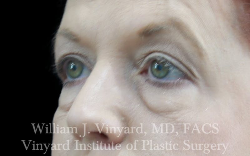 Eyelid Lift Before & After Gallery - Patient 171287 - Image 7