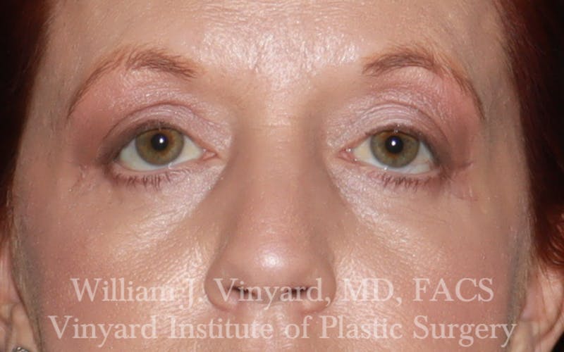 Eyelid Lift Before & After Gallery - Patient 171287 - Image 2