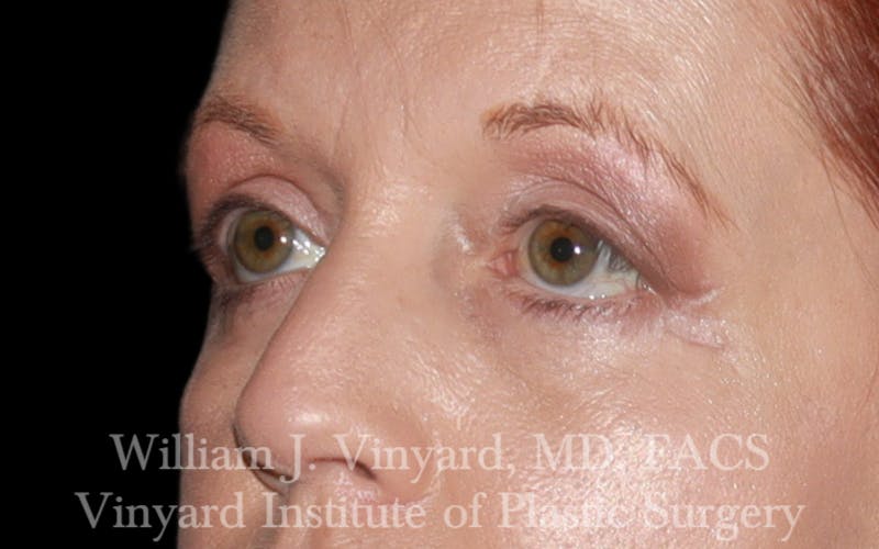 Eyelid Lift Before & After Gallery - Patient 171287 - Image 8