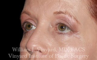 Eyelid Lift Before & After Gallery - Patient 171287 - Image 8
