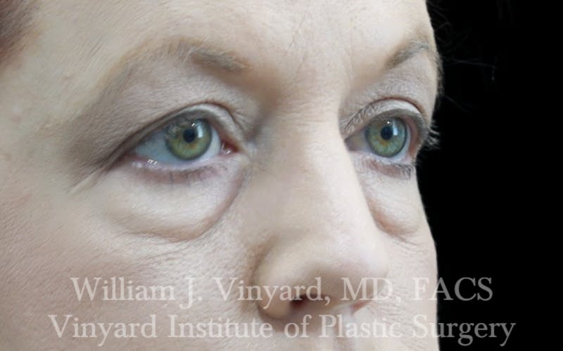 Eyelid Lift Before & After Gallery - Patient 171287 - Image 3
