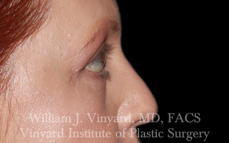 Eyelid Lift Before & After Gallery - Patient 171287 - Image 6