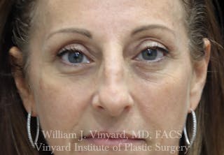 Eyelid Lift Before & After Gallery - Patient 265389 - Image 2