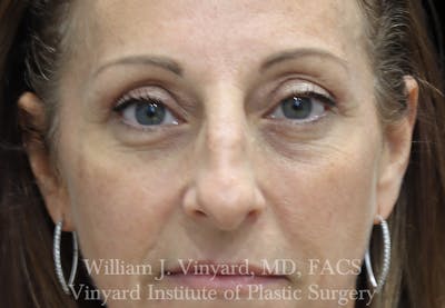 Eyelid Lift Before & After Gallery - Patient 265389 - Image 2