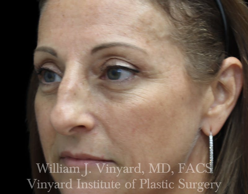 Eyelid Lift Before & After Gallery - Patient 265389 - Image 4