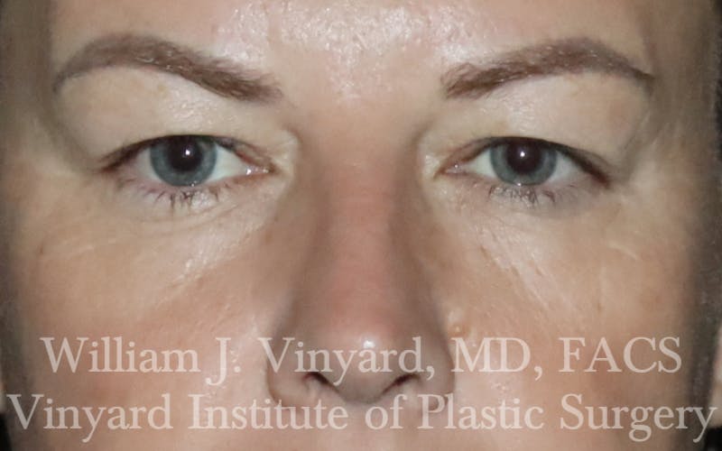 Eyelid Lift Before & After Gallery - Patient 772710 - Image 2