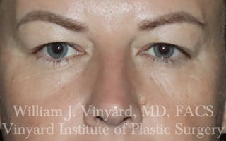 Eyelid Lift Before & After Gallery - Patient 772710 - Image 2