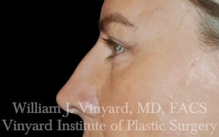 Eyelid Lift Before & After Gallery - Patient 772710 - Image 6