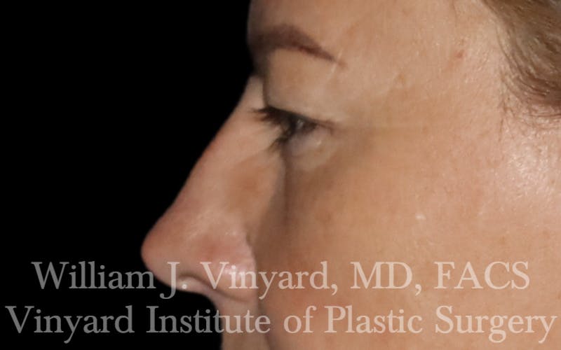 Eyelid Lift Before & After Gallery - Patient 772710 - Image 5