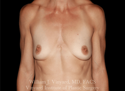 Breast Augmentation Before & After Gallery - Patient 402508 - Image 1