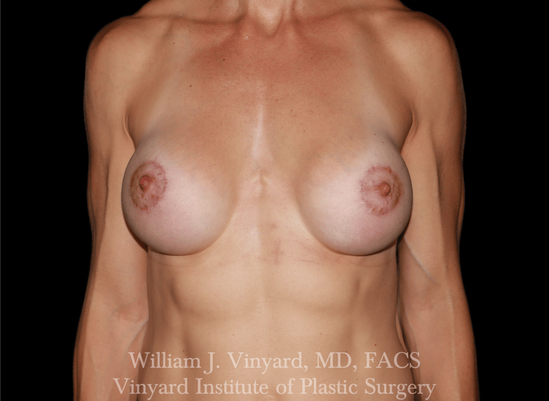 Breast Augmentation Before & After Gallery - Patient 402508 - Image 2