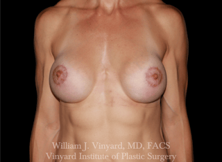 Breast Augmentation Before & After Gallery - Patient 402508 - Image 2