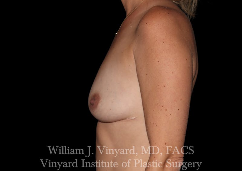 Breast Augmentation Before & After Gallery - Patient 259125 - Image 9