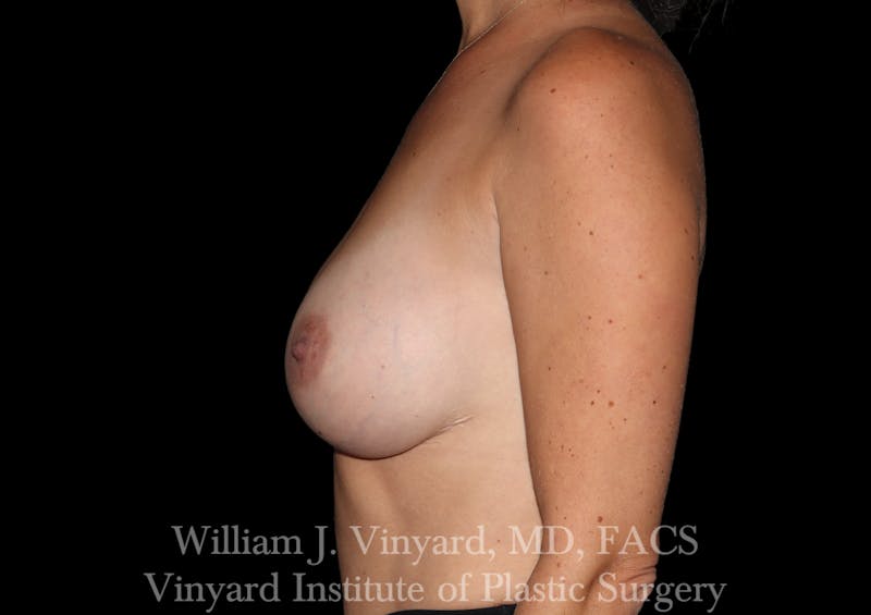 Breast Augmentation Before & After Gallery - Patient 259125 - Image 10