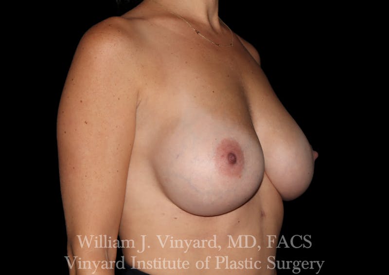 Breast Augmentation Before & After Gallery - Patient 259125 - Image 4