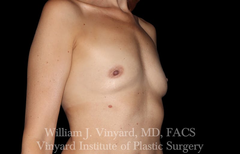 Breast Augmentation Before & After Gallery - Patient 327312 - Image 3