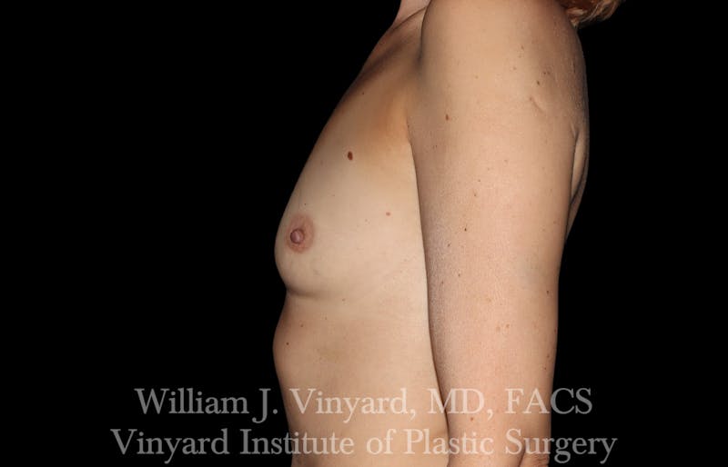 Breast Augmentation Before & After Gallery - Patient 327312 - Image 9