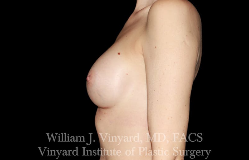 Breast Augmentation Before & After Gallery - Patient 327312 - Image 10