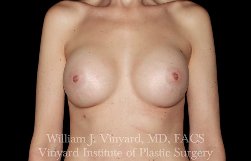 Breast Augmentation Before & After Gallery - Patient 327312 - Image 2