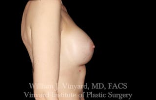 Breast Augmentation Before & After Gallery - Patient 327312 - Image 6