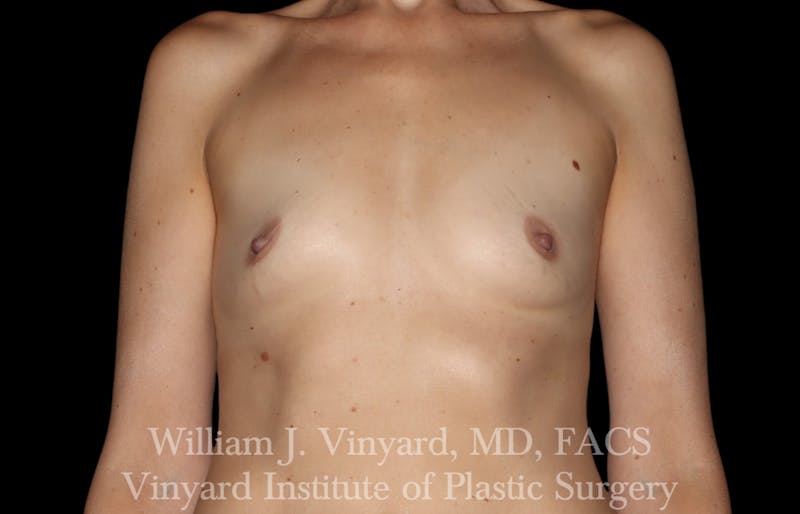 Breast Augmentation Before & After Gallery - Patient 327312 - Image 1