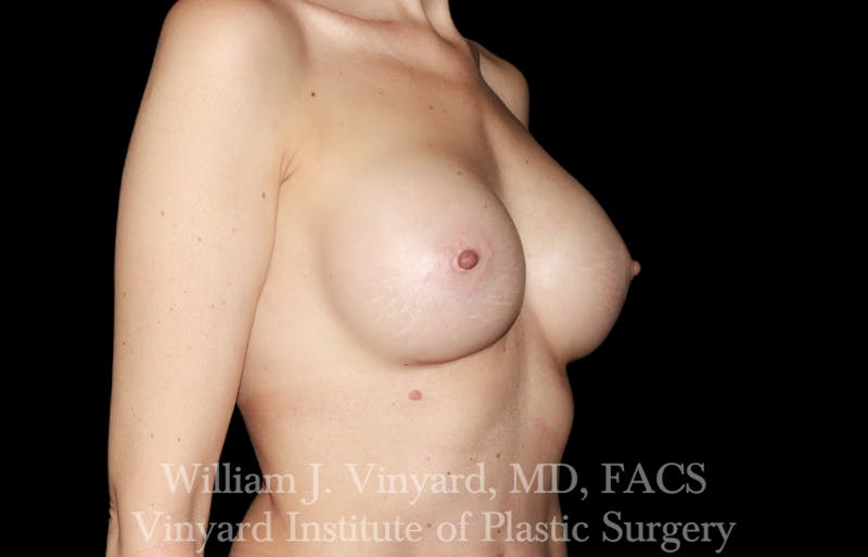 Breast Augmentation Before & After Gallery - Patient 327312 - Image 4
