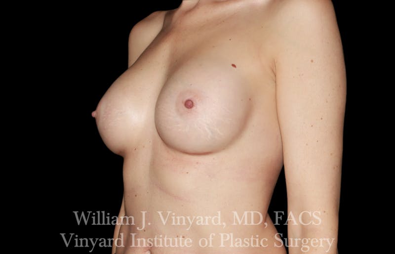 Breast Augmentation Before & After Gallery - Patient 327312 - Image 8
