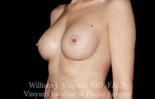 Breast Augmentation Before & After Gallery - Patient 327312 - Image 8