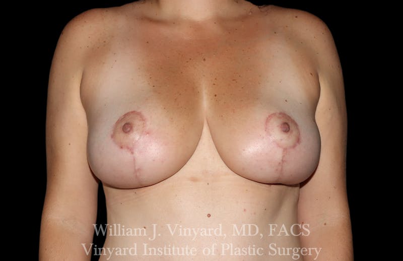 Breast Lift Before & After Gallery - Patient 169577 - Image 2
