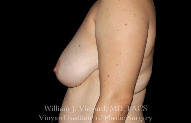Breast Lift Before & After Gallery - Patient 169577 - Image 5