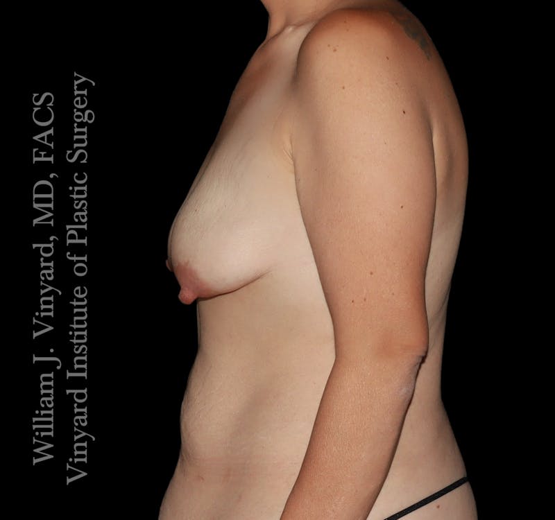 Breast Lift + Augmentation Before & After Gallery - Patient 666771 - Image 5