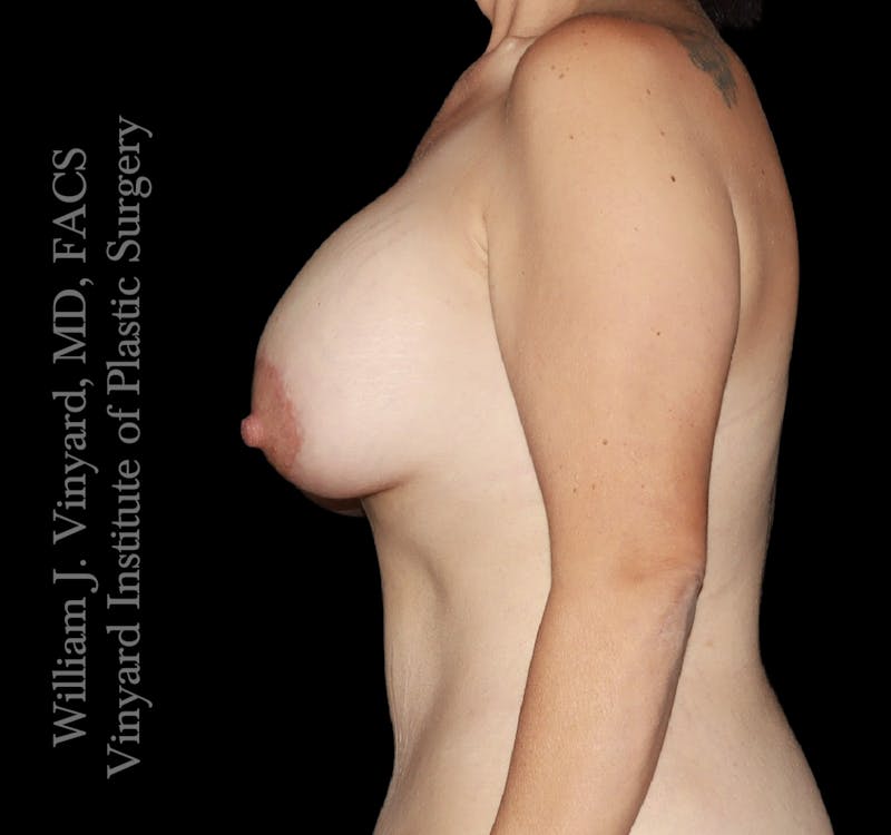 Breast Lift + Augmentation Before & After Gallery - Patient 666771 - Image 6