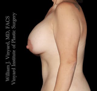 Breast Lift + Augmentation Before & After Gallery - Patient 666771 - Image 6