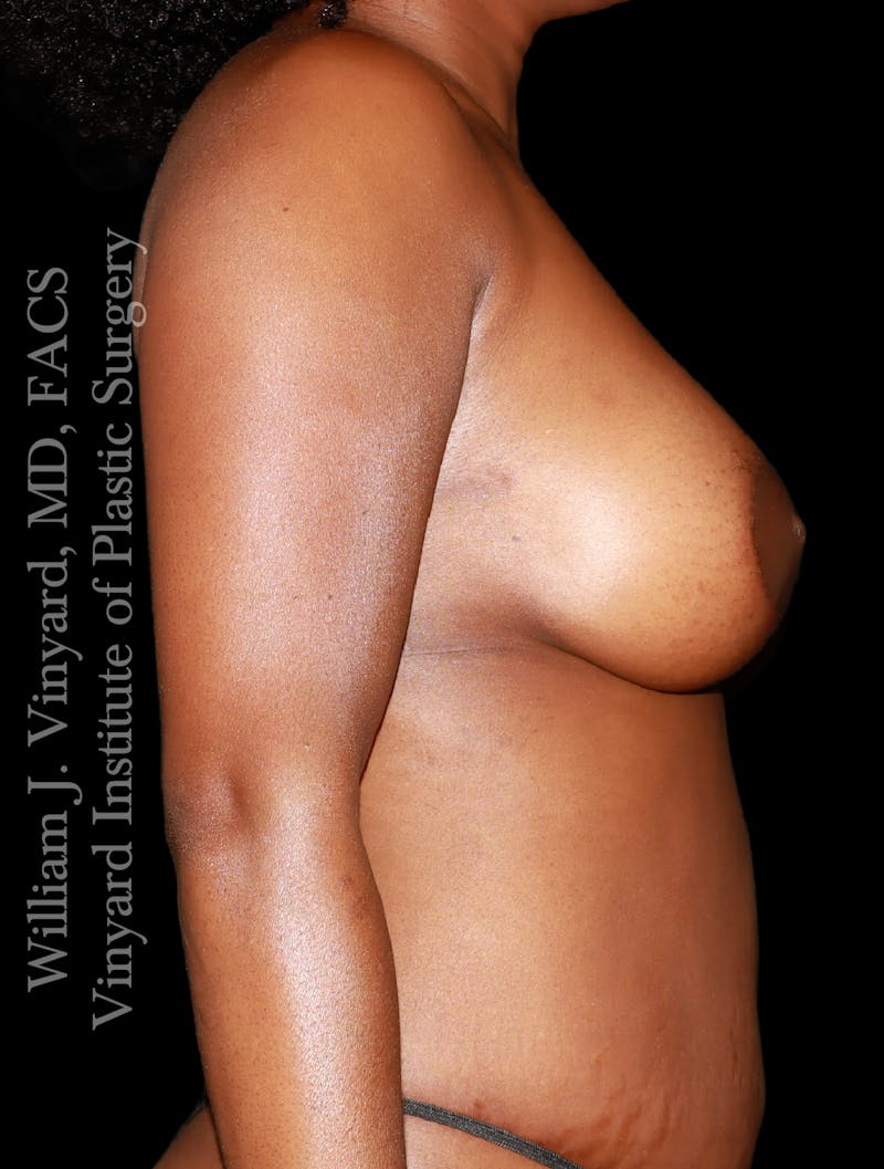 Breast Augmentation Before & After Gallery - Patient 318880 - Image 6