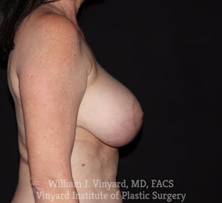 Breast Implant Exchange Before & After Gallery - Patient 262290 - Image 6