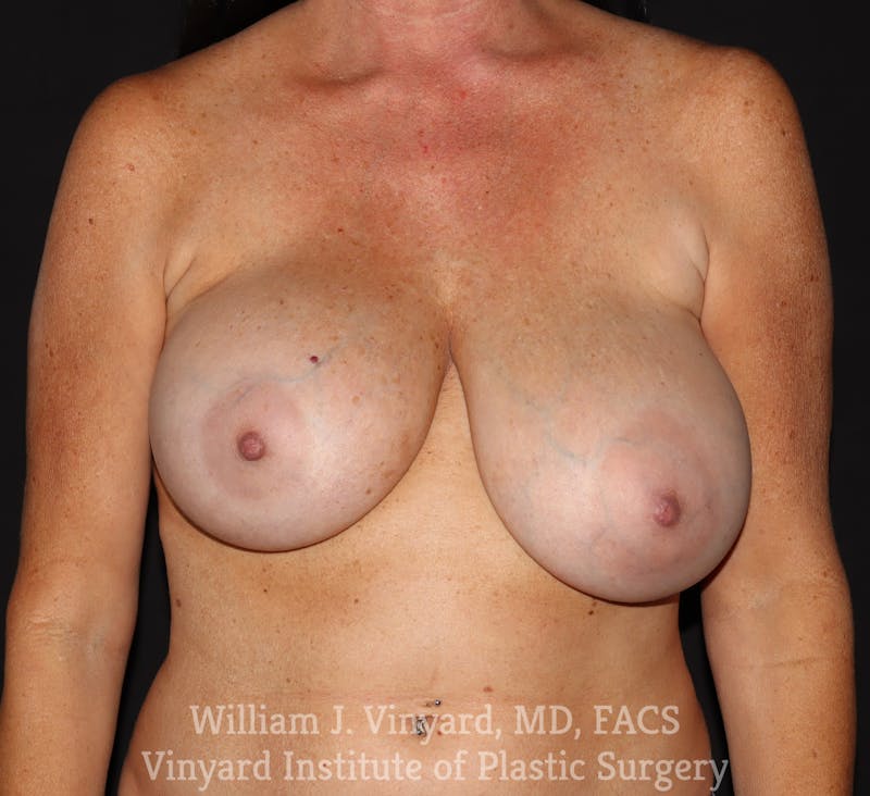 Breast Implant Exchange Before & After Gallery - Patient 262290 - Image 1