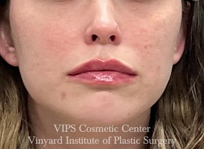 Dermal Fillers Before & After Gallery - Patient 127421 - Image 2