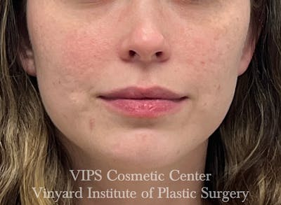 Dermal Fillers Before & After Gallery - Patient 127421 - Image 1